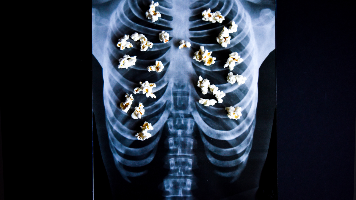 Prześwietlenie płuc, na którym rozłożony je popcorn symbolizujący zapalenie oskrzelików